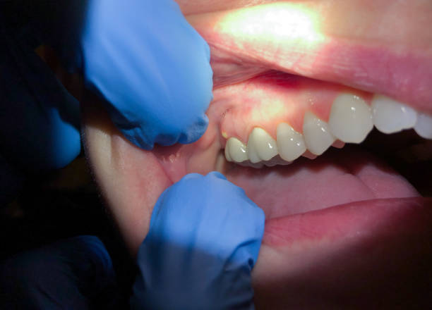 Best Emergency Treatment for Dental Infections or Abscesses in West Newton, PA